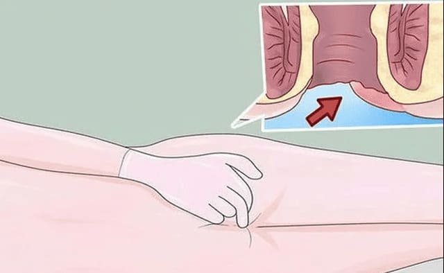 Xuất hiện khối sưng cứng như hạch – đau nhói khi chạm vào