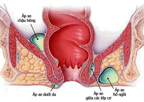 Apxe hậu môn liệu có thể tự khỏi được hay không?