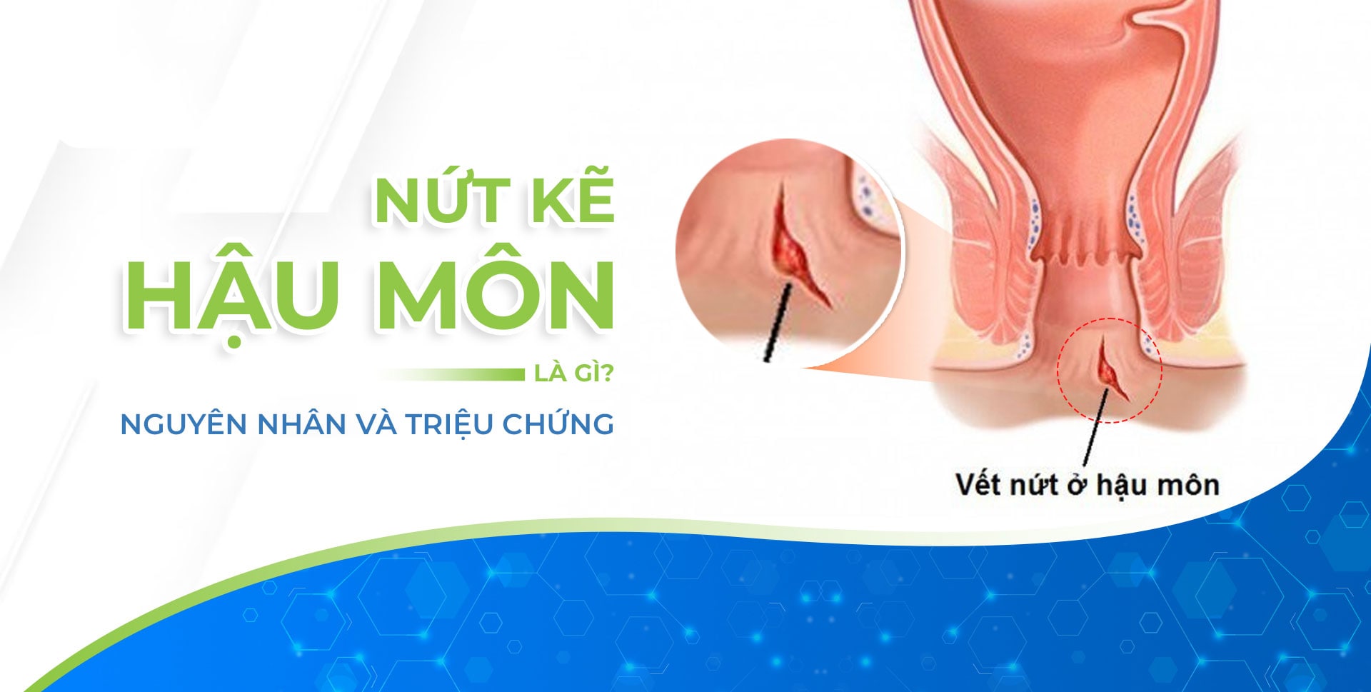 Thông tin tổng quan về căn bệnh nứt kẽ hậu môn
