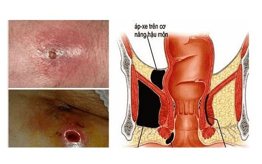 Áp xe hậu môn có nguy hiểm không?