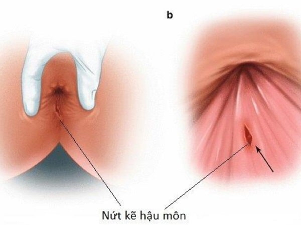 Thông tin chung về bệnh lý nứt kẽ hậu môn