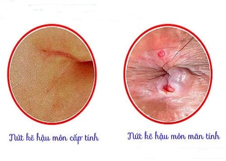 Nứt kẽ hậu môn mãn tính