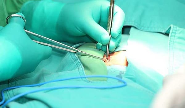 Biến chứng sau khi phẫu thuật có thể xảy ra