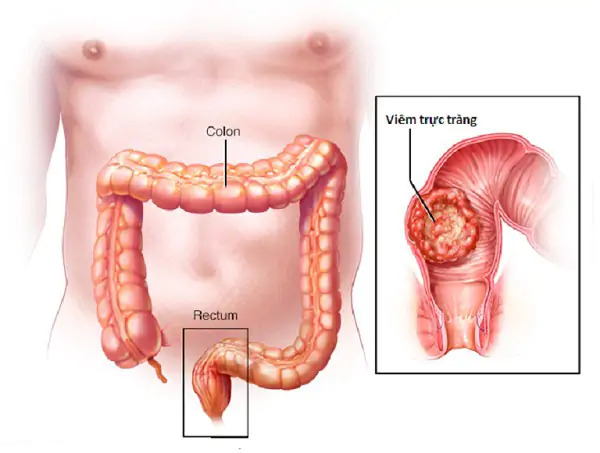 Do 1 số các bệnh lý ở hậu môn trực tràng