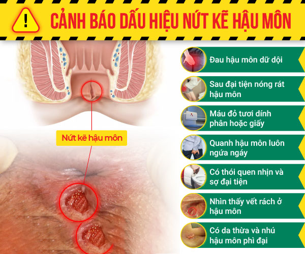 Nhận biết các triệu chứng của bệnh nứt kẽ hậu môn điển hình nhất