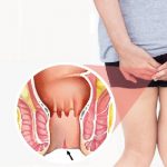 Nứt kẽ hậu môn có nguy hiểm gì không ?