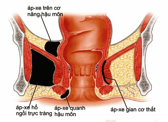 Bệnh lý apxe hậu môn