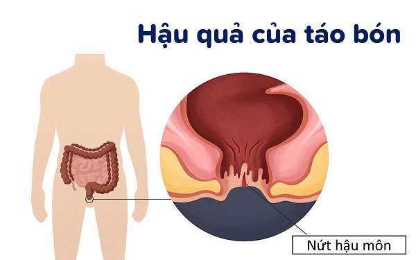 Nguyên nhân dẫn đến táo bón nứt kẽ hậu môn không thể bỏ qua!