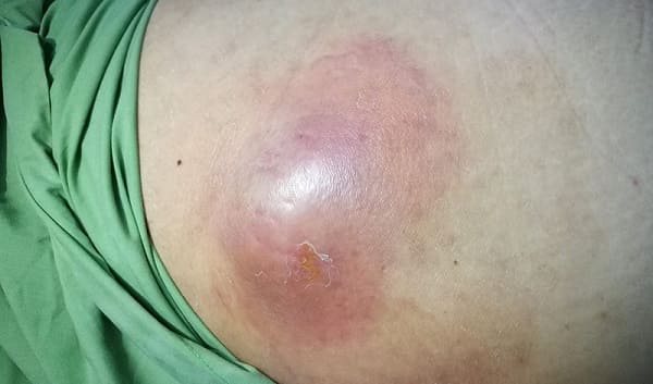 Triệu chứng apxe hậu môn