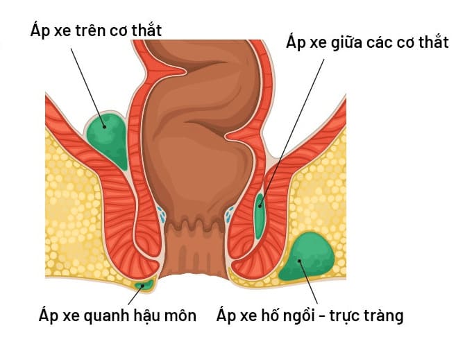 Các triệu chứng apxe hậu môn kéo dài có thật sự nguy hiểm không?