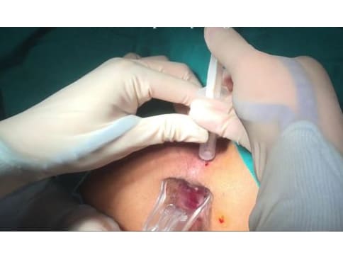 Phương pháp điều trị apxe hậu môn