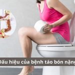 Dấu hiệu của bệnh táo bón nặng
