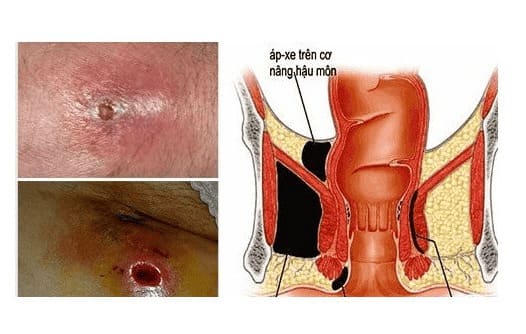 Áp xe hậu môn có nguy hiểm không?