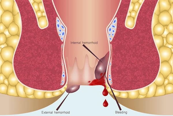 Vì sao mọi người cần chủ động can thiệp cắt trĩ ngay từ sớm?