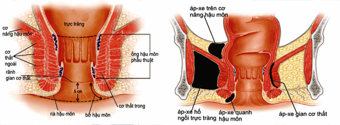 Bệnh lý apxe hậu môn