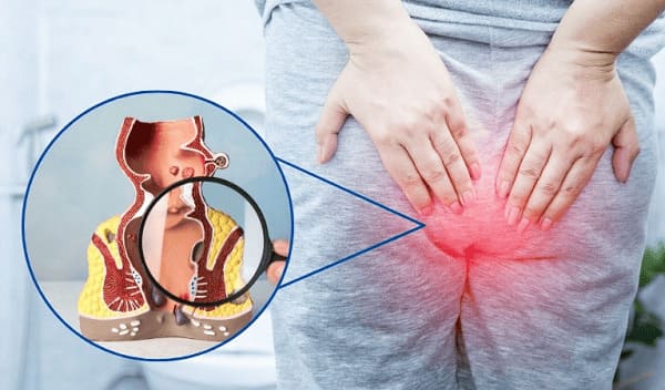Dấu hiệu của bệnh táo bón nặng - Bệnh trĩ