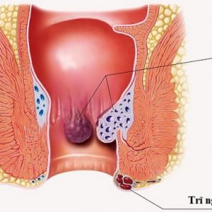 Lý do nào gây nên tình trạng ngứa hậu môn? - Do bệnh trĩ