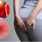 Ngứa ở hậu môn sau khi đi vệ sinh do nứt kẽ hậu môn