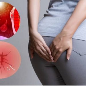 Ngứa ở hậu môn sau khi đi vệ sinh do nứt kẽ hậu môn