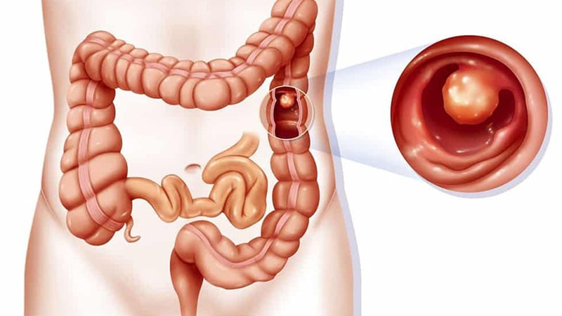 Hậu môn tiết dịch ngứa sau khi đi ngoài do polyp trực tràng.Hậu môn tiết dịch ngứa sau khi đi ngoài do polyp trực tràng.