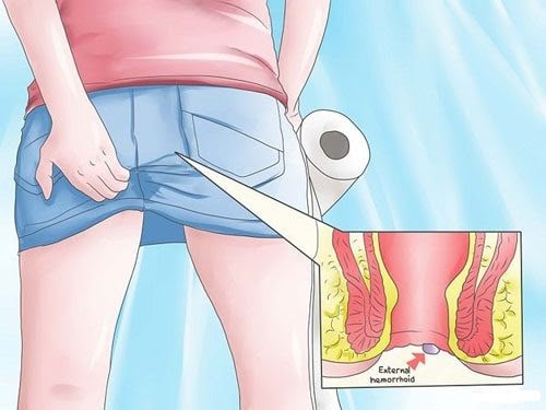 Bị ngứa vùng hậu môn sau khi đi vệ sinh thì phải làm gì?
