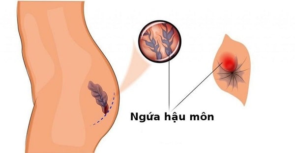 Thông tin quan trọng liên quan đến bệnh ngứa hậu môn