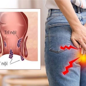 Vì sao không nên trì hoãn điều trị ngứa hậu môn và đi ngoài ra máu ?