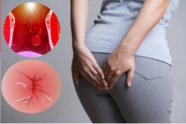 Ngứa hậu môn vào buổi sáng, có thể bạn đang mắc phải những bệnh lý này