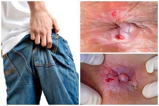 Rò hậu môn gây ra ngứa hậu môn về đêm