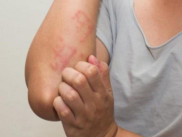 Dị ứng với thuốc gây ra ngứa hậu môn về đêm