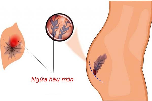 Vì sao tôi bị ngứa hậu môn về đêm?