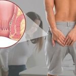Ngứa vùng hậu môn do nguyên nhân bệnh lý 