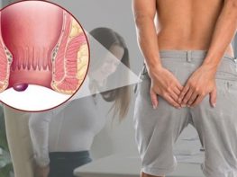 Ngứa vùng hậu môn do nguyên nhân bệnh lý 