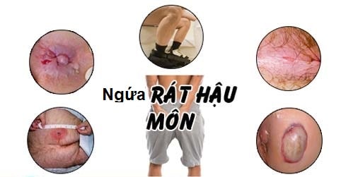 Các nguyên nhân gây ngứa hậu môn có nguy hiểm không ?