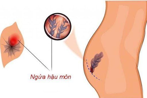 Ngứa hậu môn là biểu hiện gì ?
